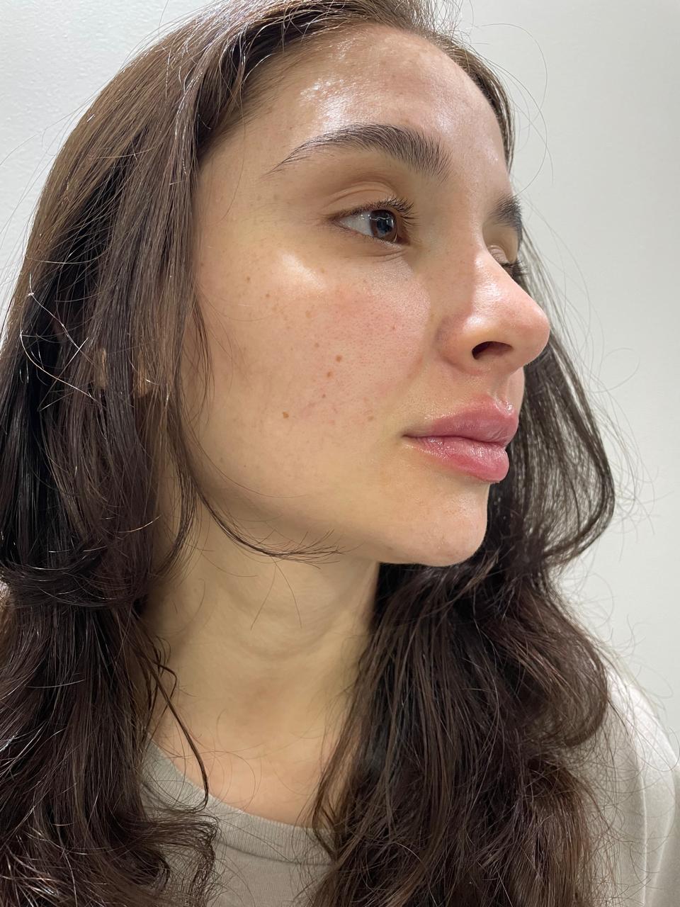 Depois do tratamento